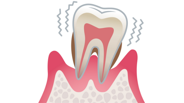 重度歯周炎